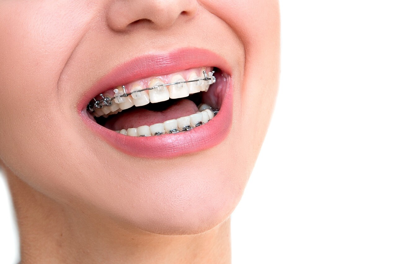 How Long Does it Take For Braces to Straighten Teeth?